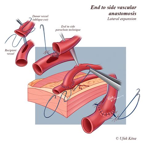 End to side vascular anastomosis - Lateral expansion :: Behance