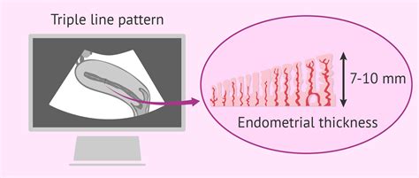 Endometrial Preparation for Implantation After IVF Embryo Transfer