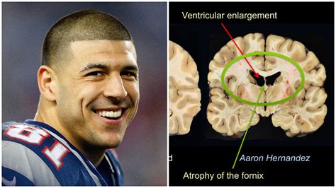 Aaron Hernandez & CTE: Photos Show Severe Brain Damage