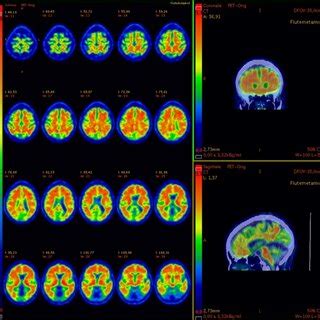 ¹⁸F-amyloid PET/CT in sagittal and coronal views and PET-only scan in ...