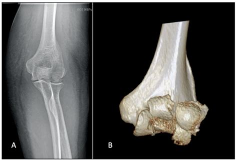 JFMK | Free Full-Text | Coronal Shear Fractures of the Distal Humerus