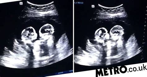 Twin babies filmed 'fighting' inside the womb | Metro News