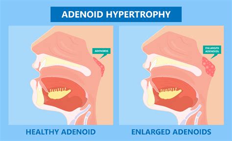 Tonsils and Adenoids: Common Problems, Pre and Post-surgery Care