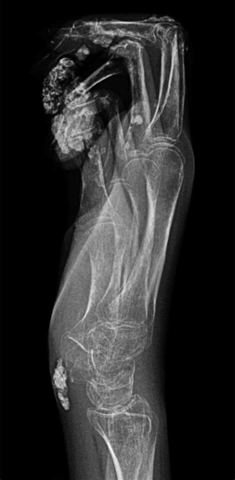 Scleroderma and Calcinosis & Raynauds