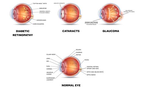 Glaucoma And Diabetes - DiabetesWalls