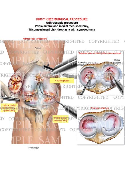 Right knee arthroscopic sugery - medial meniscectomy - chondroplasty - synovectomy — Medical Art ...