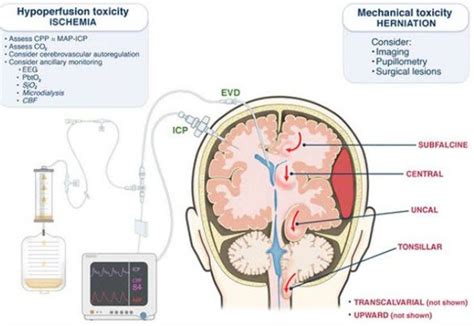 Treatment for Increased intracranial pressure - MEDizzy