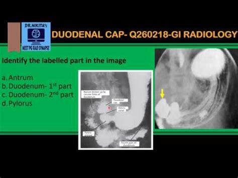 Duodenal Cap Image Clipart