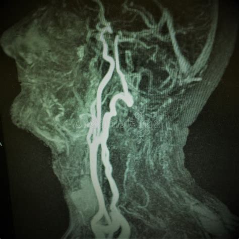 Mri Carotid Artery Complete Occlusion Stock Image - Image of radiology, left: 97862923