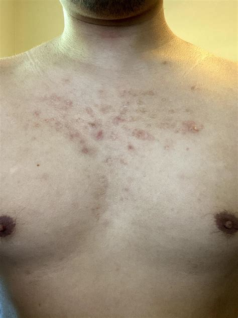 [Skin Concerns] Severe chest acne scars that are several years old. Tried differing remedies but ...