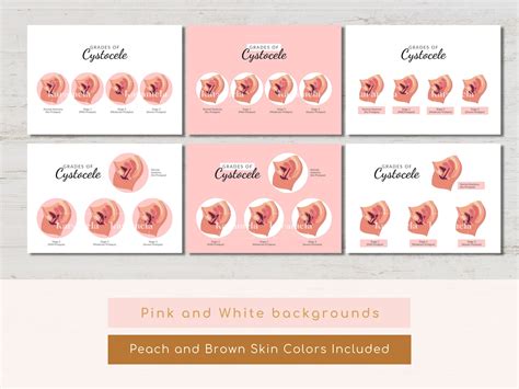 Printable Diagram of Cystocele Grading Stages of Cystocele - Etsy UK