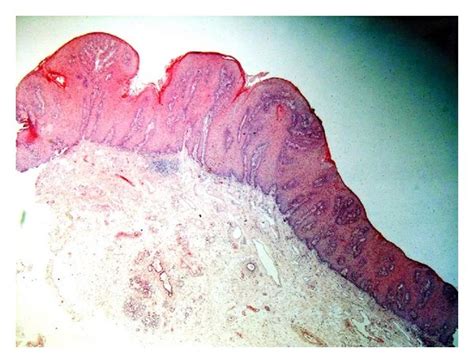 Photomicrograph of verrucous hyperplasia showing blunt surface...