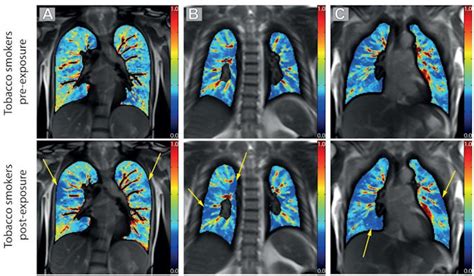 MRI offers noninvasive way to assess effects of vaping, smoking