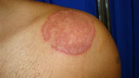 ringworm images - pictures, photos