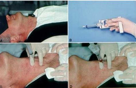 Fine-Needle Aspiration of the Thyroid Gland - Endotext - NCBI Bookshelf