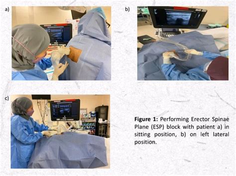 Performing Erector Spinae Plane (ESP) block with patient a) in sitting ...