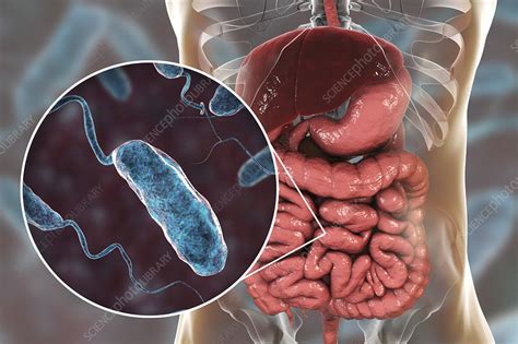 Cholera infection, illustration - Stock Image - F023/9704 - Science Photo Library