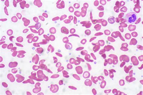 Sickle Cell Anemia | Peripheral blood smear | Ed Uthman | Flickr