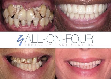 All-On-Four Dental Implant Procedure - Titanium vs. Metal-Free Zirconia Implants - Holistic and ...