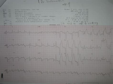 Medical Images Gallery: Anterior Wall MI ECG : ECG changes before and ...