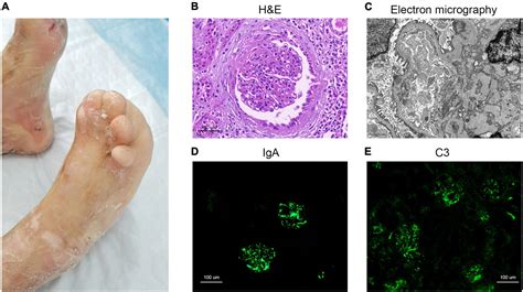 Epidermolysis Bullosa Histology