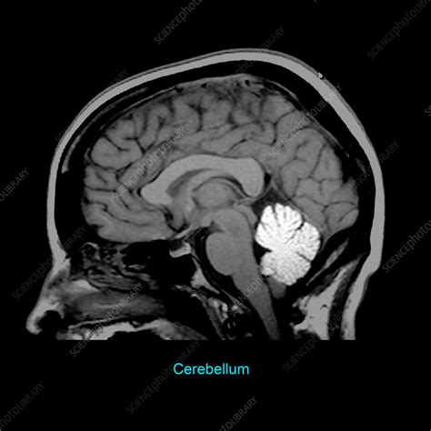 Cerebellum Anatomy Mri