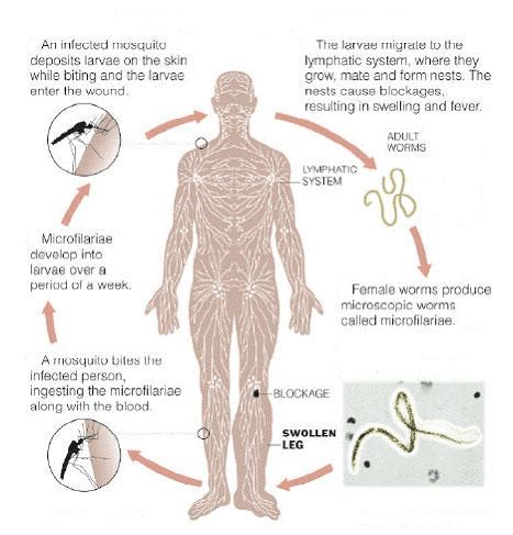 Lymphatic filariasis - INSIGHTS IAS - Simplifying UPSC IAS Exam Preparation