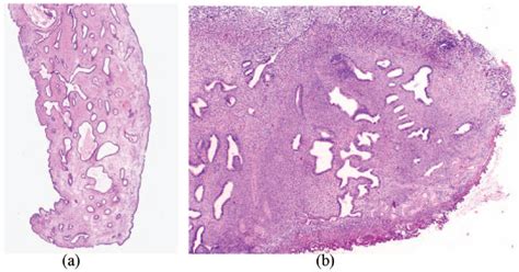 Endometrial Polyp