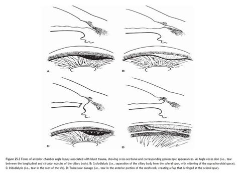 Angle recession glaucoma