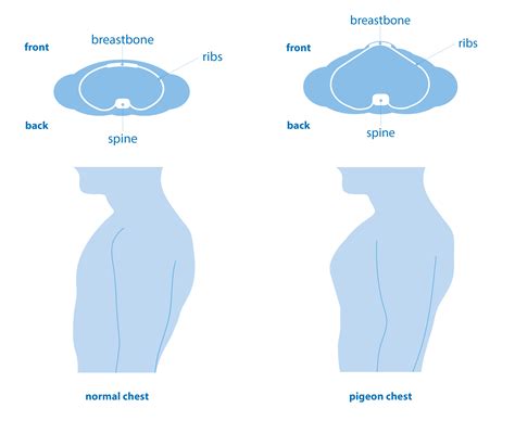 Pectus carinatum (pigeon chest) | Asthma + Lung UK