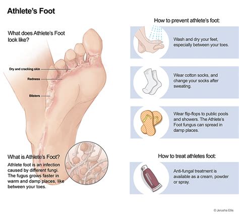 Athlete’s foot (Tinea Pedis) - Mount Lawley Physiotherapy