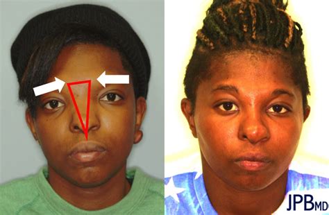 Craniofacial Surgery Before & After Photos | James P. Bradley, MD