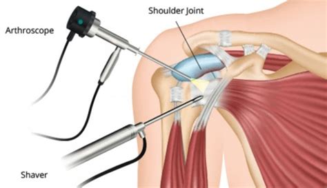 Shoulder Separation (AC Separation) - Orthopedic Surgery at OSMI