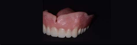 A Primer on Soft Denture Liners - Spear Education