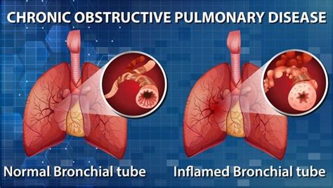 Chronic Obstructive Pulmonary Disease Copd