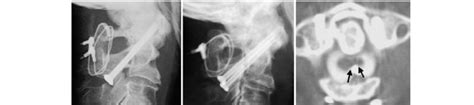 Case 2. Left: Plain radiograph of initial posterior atlantoaxial fusion... | Download Scientific ...