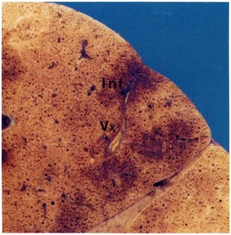 Pulmonary infarcts Shown here are an HRCT (A) and a fixed lung section... | Download Scientific ...