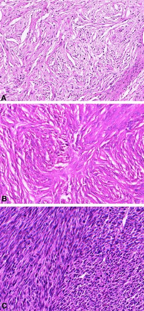 Histopathology of peripheral nerve sheath tumors. (a) Spindle cell... | Download Scientific Diagram