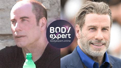 9+ John Travolta Hair Transplant - AidynnWeston