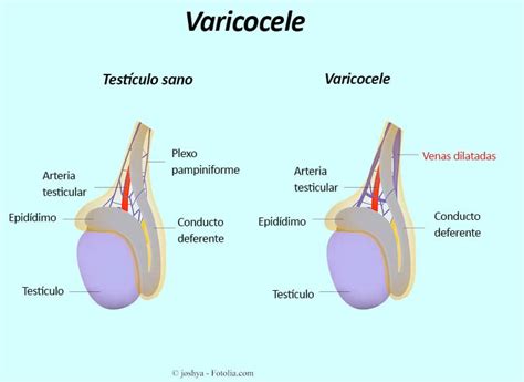 Varicocele testicular: diagnóstico, tratamiento, remedios