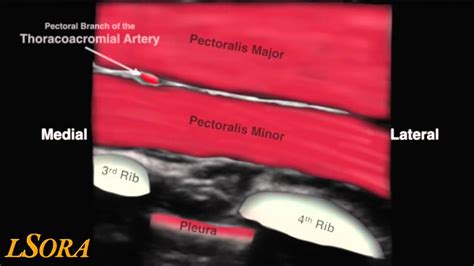 LSORA: US guided PECS II (2) Block - YouTube