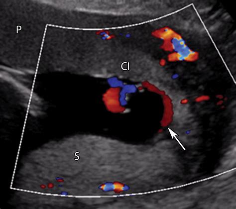 Succenturiate Lobe Placenta Ultrasound