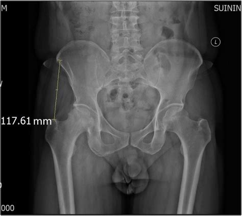 ASIS-GTD: the distance between the anterior superior iliac spine and... | Download Scientific ...