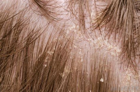 Home Remedies for Severe Dandruff | Healthy Central Blog