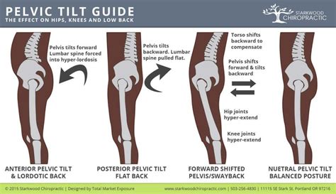 Fixing Posterior Pelvic Tilt - Hip Tilt Causes & Fixes