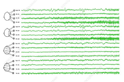 Brain waves in epilepsy - Stock Image - M150/0284 - Science Photo Library