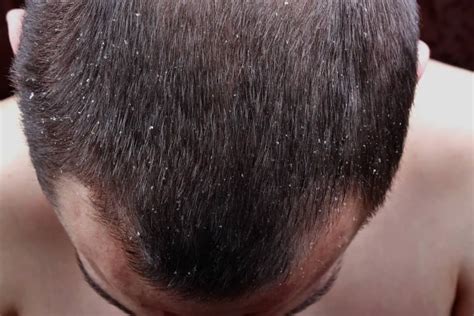What Causes Dry Scalp: Factors, Symptoms, and Treatments - Bald & Beards
