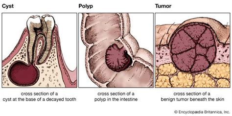 Polyp Versus Retention Cyst | My XXX Hot Girl