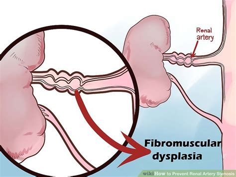 How to Prevent Renal Artery Stenosis: 15 Steps (with Pictures)