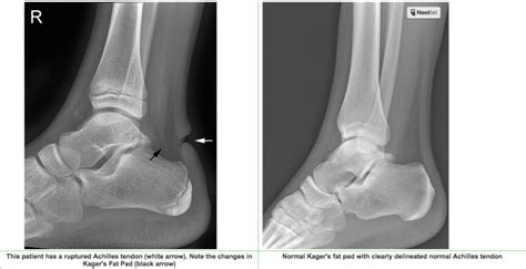 Achilles Tendon Rupture – Core EM